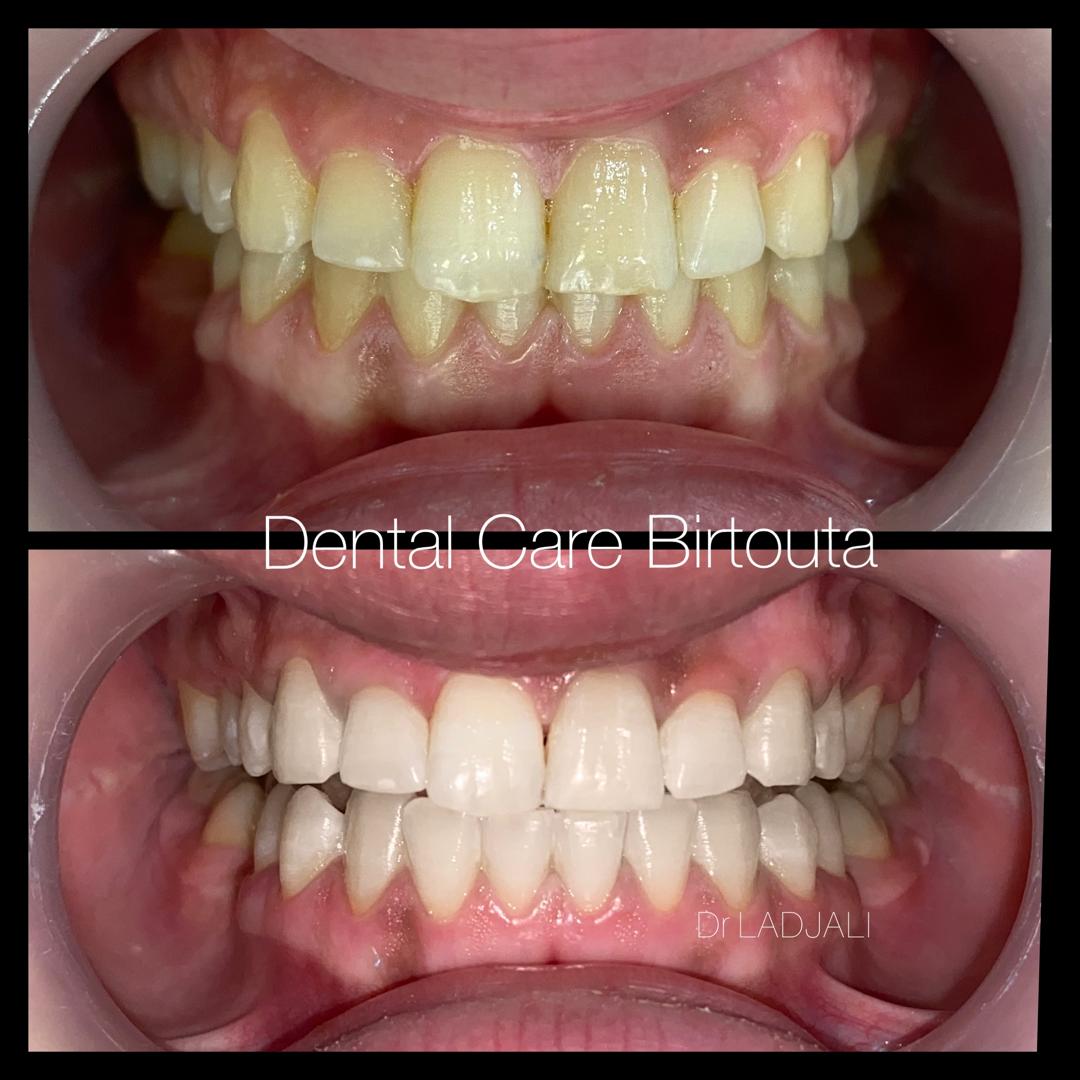 Vue du sourire de face — avant