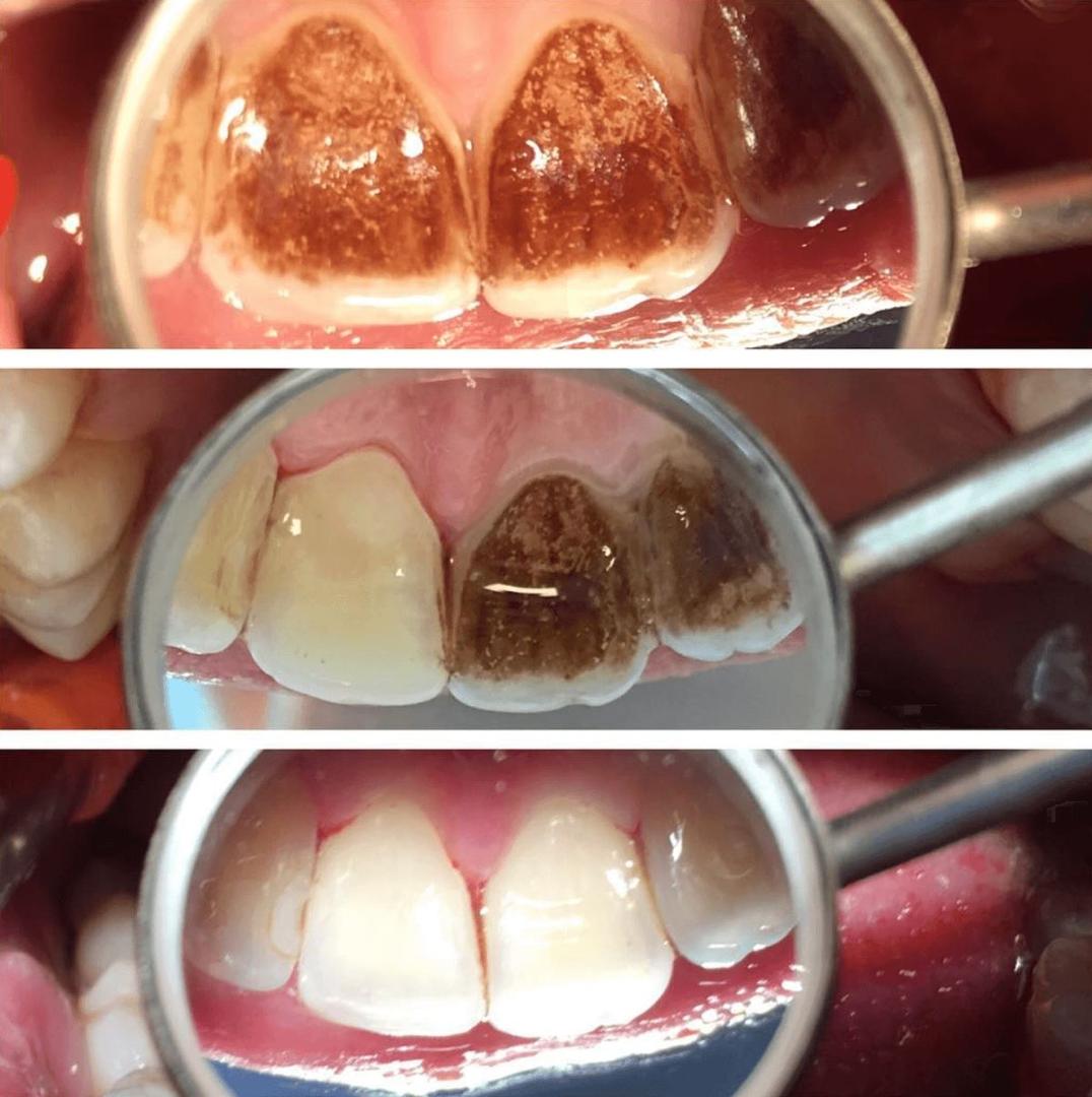 Face interne des dents vue dans un miroir dentaire — avant