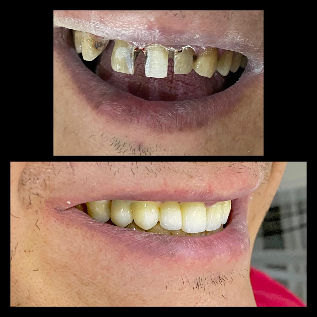 Vue du sourire de face — avant